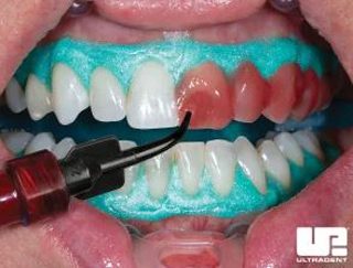 Why Do I Have Cracks in My Teeth After Zoom Whitening?